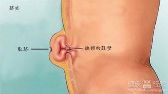 成人脐疝艾灸视频大全