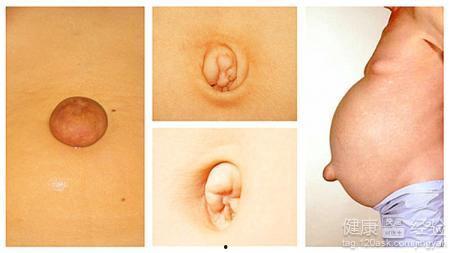 成人脐疝艾灸视频大全