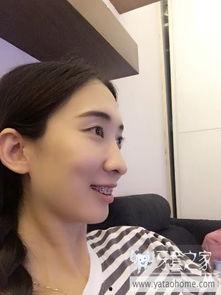 成人暴牙矫正视频,视频带你了解矫正技巧与效果