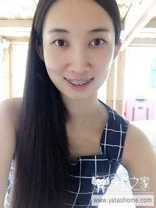 成人暴牙矫正视频,视频带你了解矫正技巧与效果